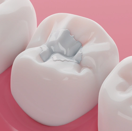 Illustration of a tooth with a composite filling
