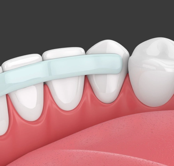 Illustration of teeth receiving dental bonding treatment