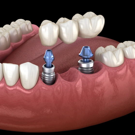 Illustration of a dental bridge in the mouth