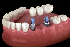 Illustration of a dental implant bridge in the mouth