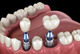 Illustration of dental implant crowns in the mouth