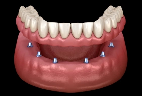 Illustration of a dental implant supported denture in the gums