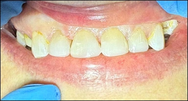 chipped front tooth after