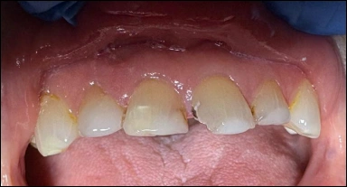 chipped front tooth before