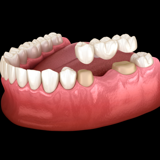 Dental Bridges in Overland Park, KS & Gladstone, MO