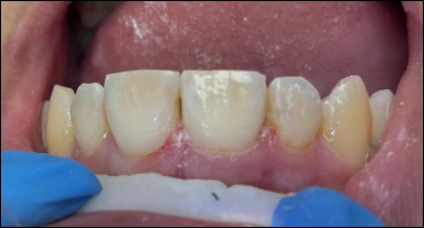 front teeth cosmetic restoration after