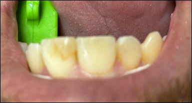 front teeth cosmetic restoration before
